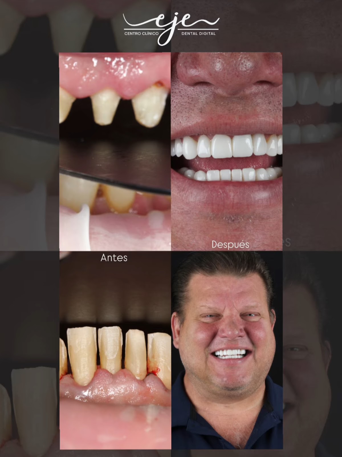 Hollywood Veneers - Pereira | EJE Centro Clinico Dental - Digital Dentistry