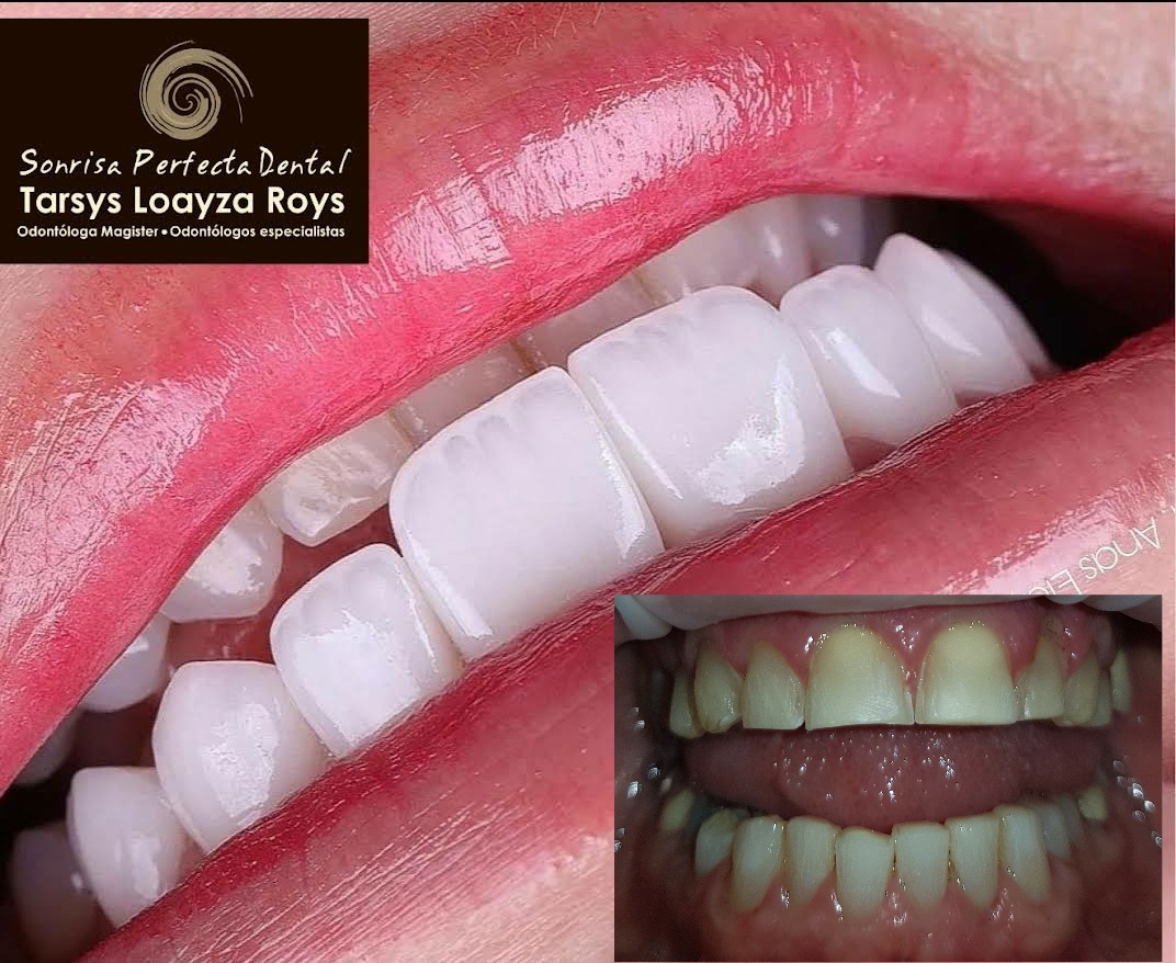 Sonrisa Perfecta Dental - Tarsys Loayza Roys photo 2